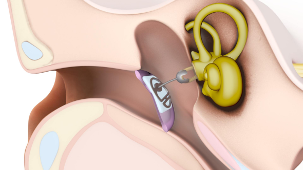 Prótesis para timpanoplastia Prótesis para timpanoplastia