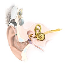 Anatomy Cochlear Implant EAS