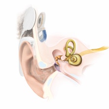 Anatomie Cochlea-Implantat EAS